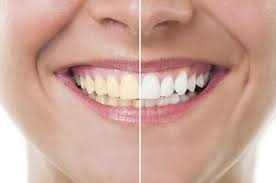15 علاج منزلي فعال لإزالة الجير والبلاك من الأسنان - العلاجات المنزلية لإزالة الجير والبلاك من الأسنان 