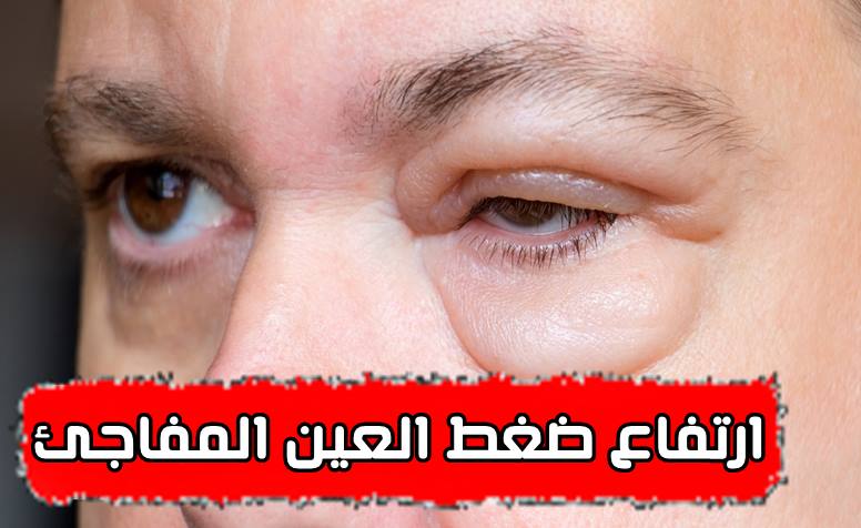 10 أعراض و 7 أسباب ارتفاع ضغط العين المفاجئ