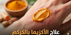 علاج الأكزيما بالكركم