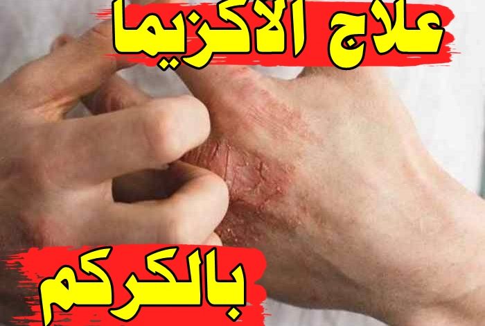 علاج الأكزيما بالكركم