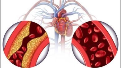 علاج انسداد الشرايين