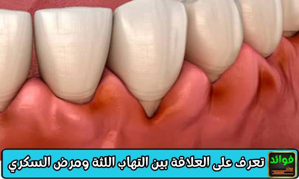 العلاقة بين التهاب اللثة ومرض السكري