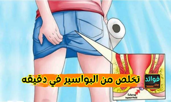 تخلص من البواسير في دقيقه