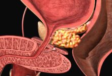 ما هو أفضل مشروب لالتهاب البروستاتا