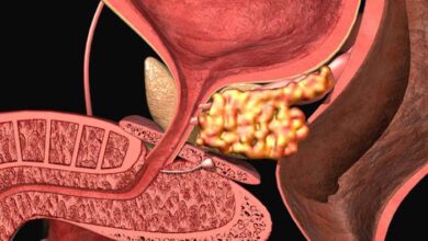 ما هو أفضل مشروب لالتهاب البروستاتا