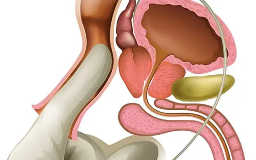 ما هو أفضل مشروب لالتهاب البروستاتا؟ خيارات طبيعية 2 ما هو أفضل مشروب لالتهاب البروستاتا