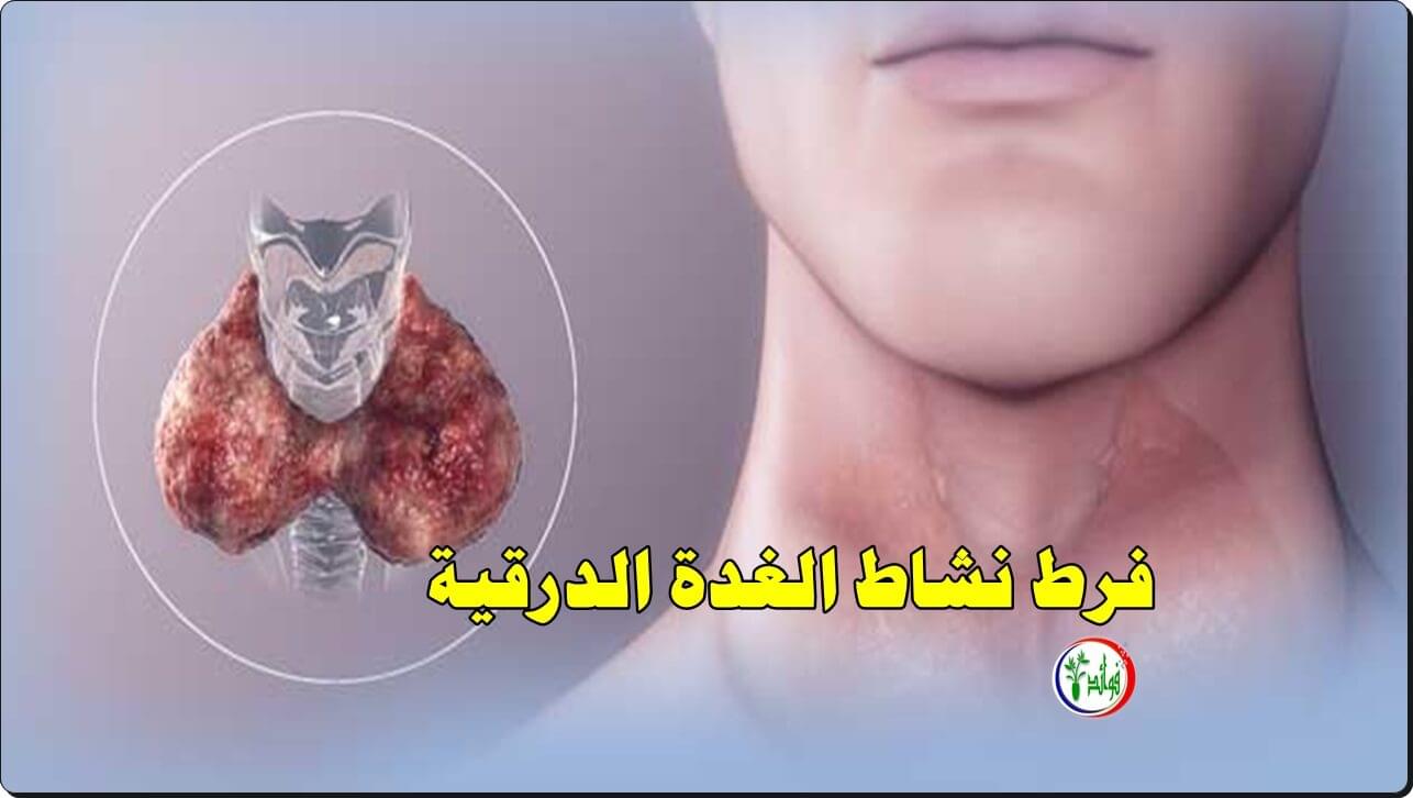 9 أعراض فرط نشاط الغدة الدرقية التي يجب أن تعرفها
