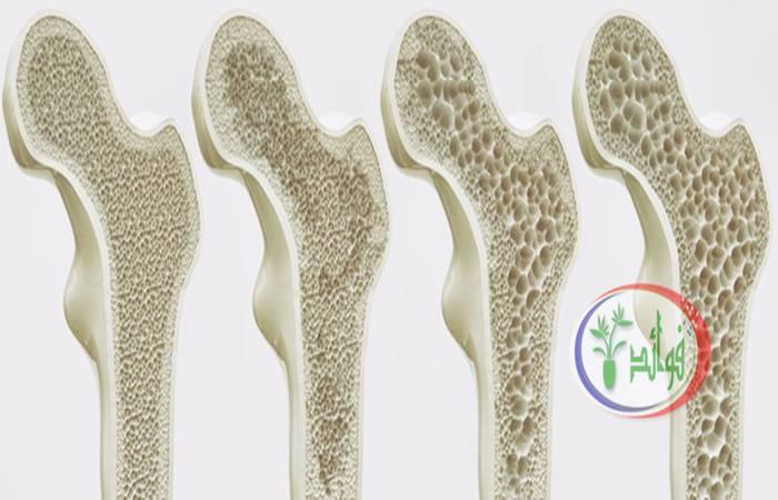 نصائح لمرضى هشاشة العظام: ما يجب أن تعرفه