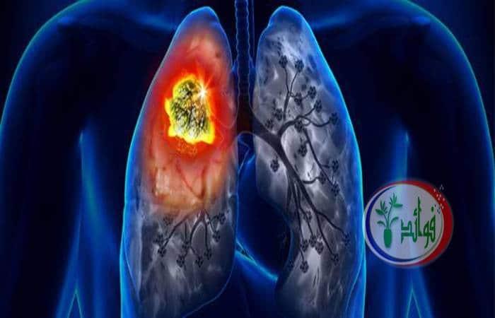 اعراض سرطان الرئة – عوامل تزيد من الإصابة بسرطان الرئة