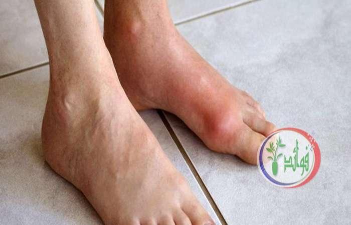 علاج مرض النقرس نهائياً